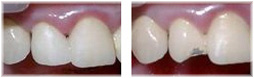 הלבנת שיניים-תיקון כתר
